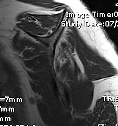 Supraspinatous fatty infiltration grade 2